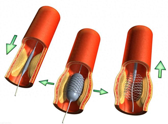 乐鱼体育：救命的心脏支架单价从700元重新涨到30000元真相到底是什么？(图4)